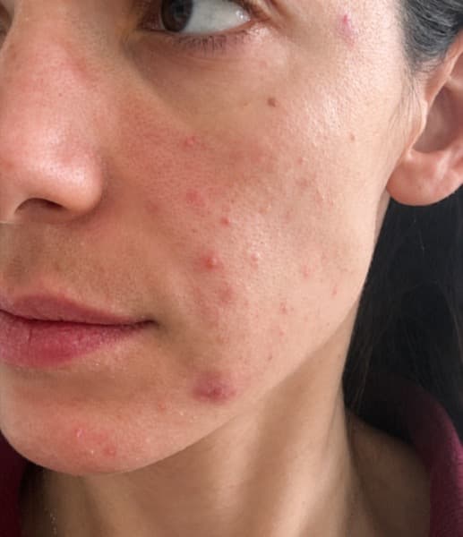 Sam, 29, Breakouts and texture, before
