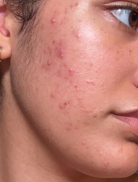 Zoey, 19, Acne and uneven tone, before